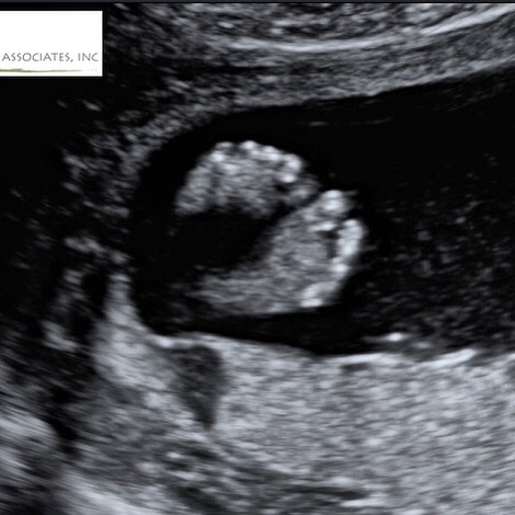 Supermodel Anne V used a sonogram showing her little one's