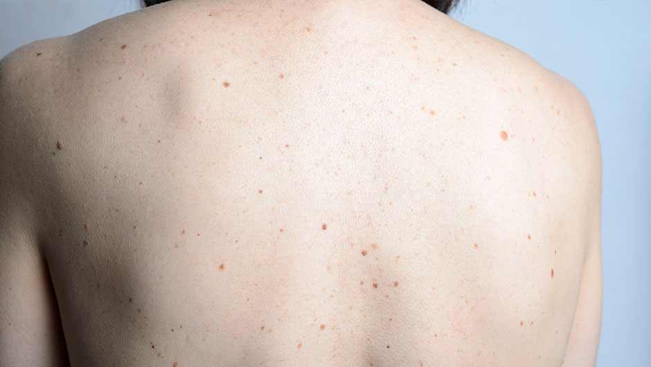 What Are Moles | Are Moles Skin Cancer - SHEfinds