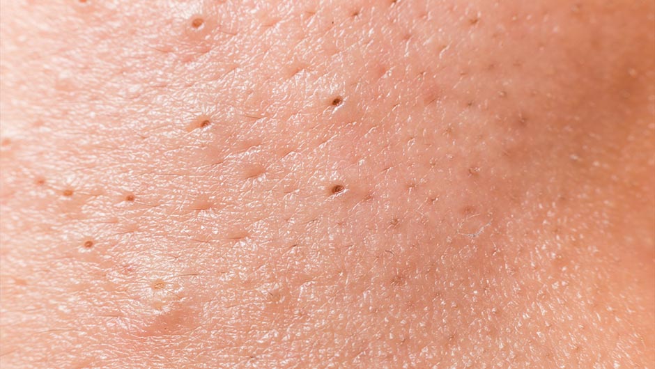 The One Thing You Should Never Do To Your Blackheads - SHEfinds