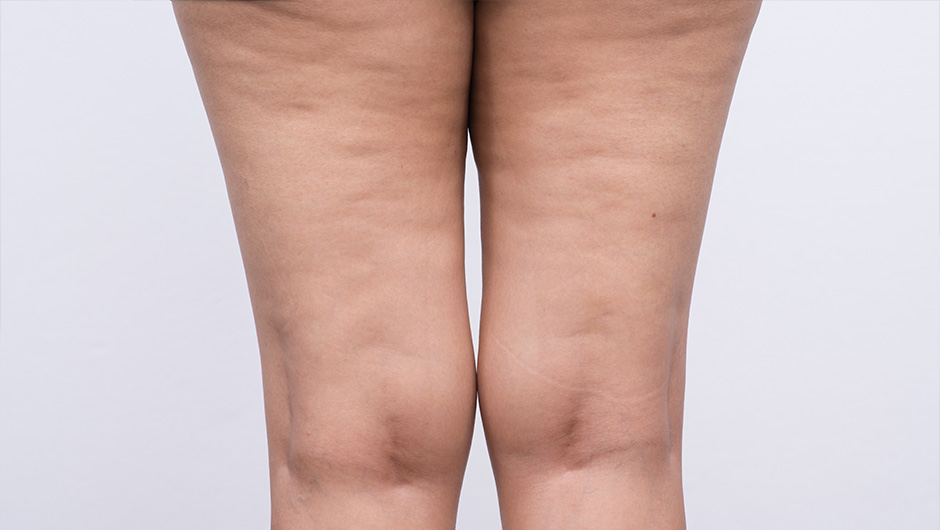 The Worst Thing To Eat If You Have Cellulite According To A