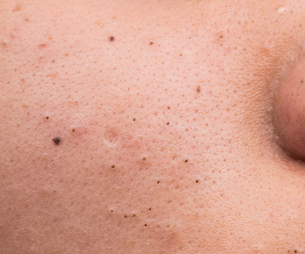 Blackheads