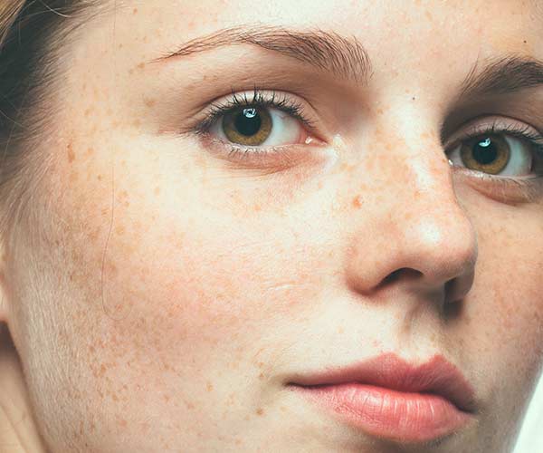 what-your-freckles-are-telling-you-about-your-skin-shefinds