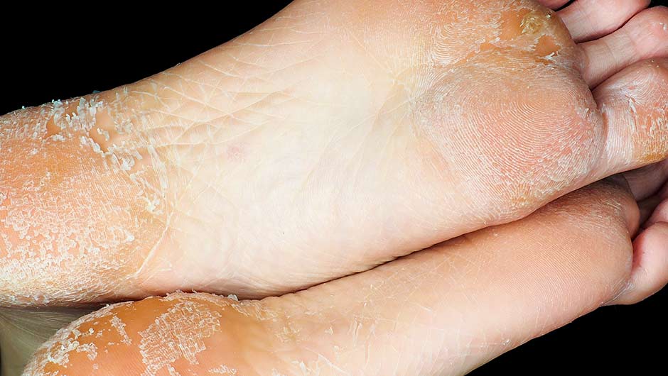 bottom of feet cracking skin