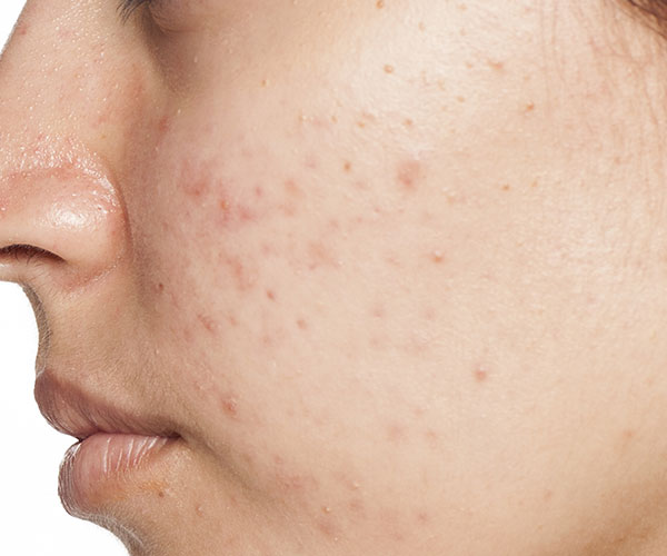 cystic acne product