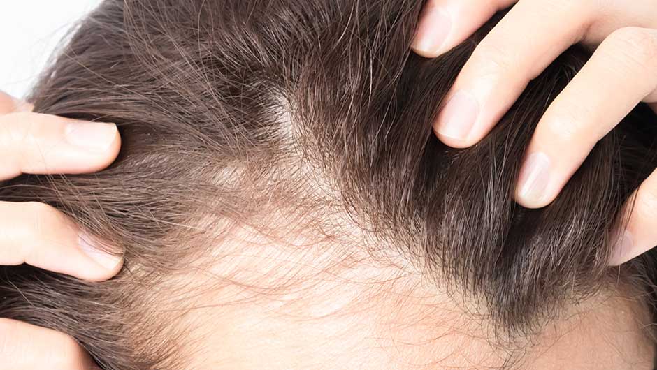 The One Supplement You Should Take Every Morning For Bald Spots According To A Dermatologist Shefinds