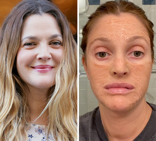 Drew Barrymore facial treatment