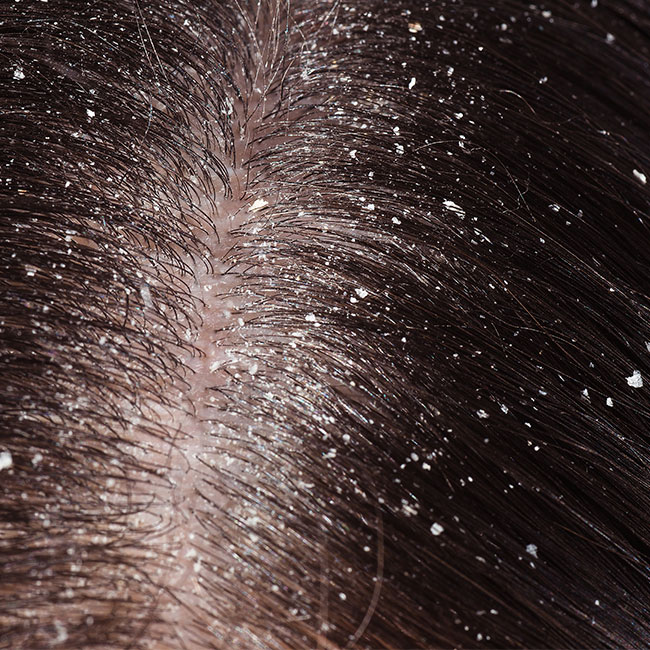 product causes dandruff