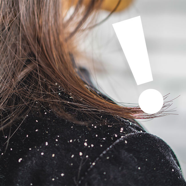 product causes dandruff