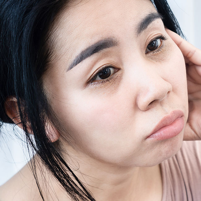 Puffy Eyes, Dark Circles, and Bags: Dermatologists Explain the Difference