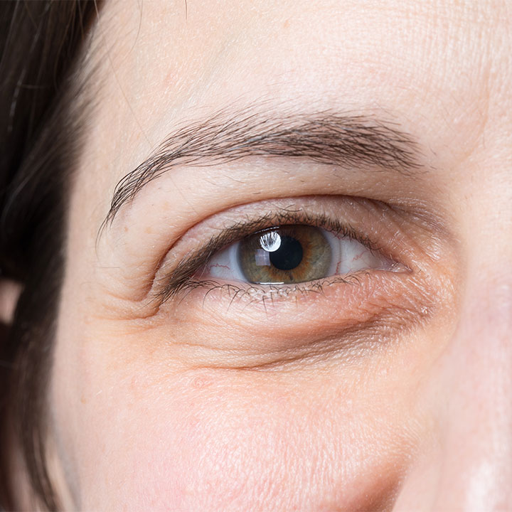 Puffy eyes - big skincare mistake that can make your eyes puffy