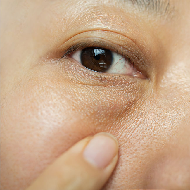 What Are Puffy Eyes? 3 Simple Ways To Reduce Swollen, Puffy Eyes