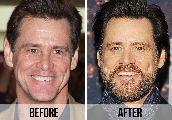 Celebrity Dental Implants And Veneers Before And After Shefinds