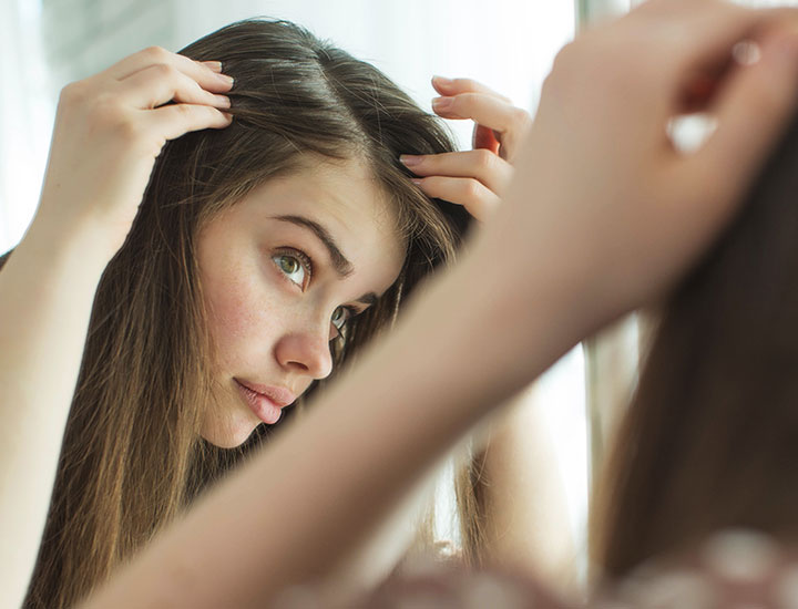 flaky-scalp-dandruff