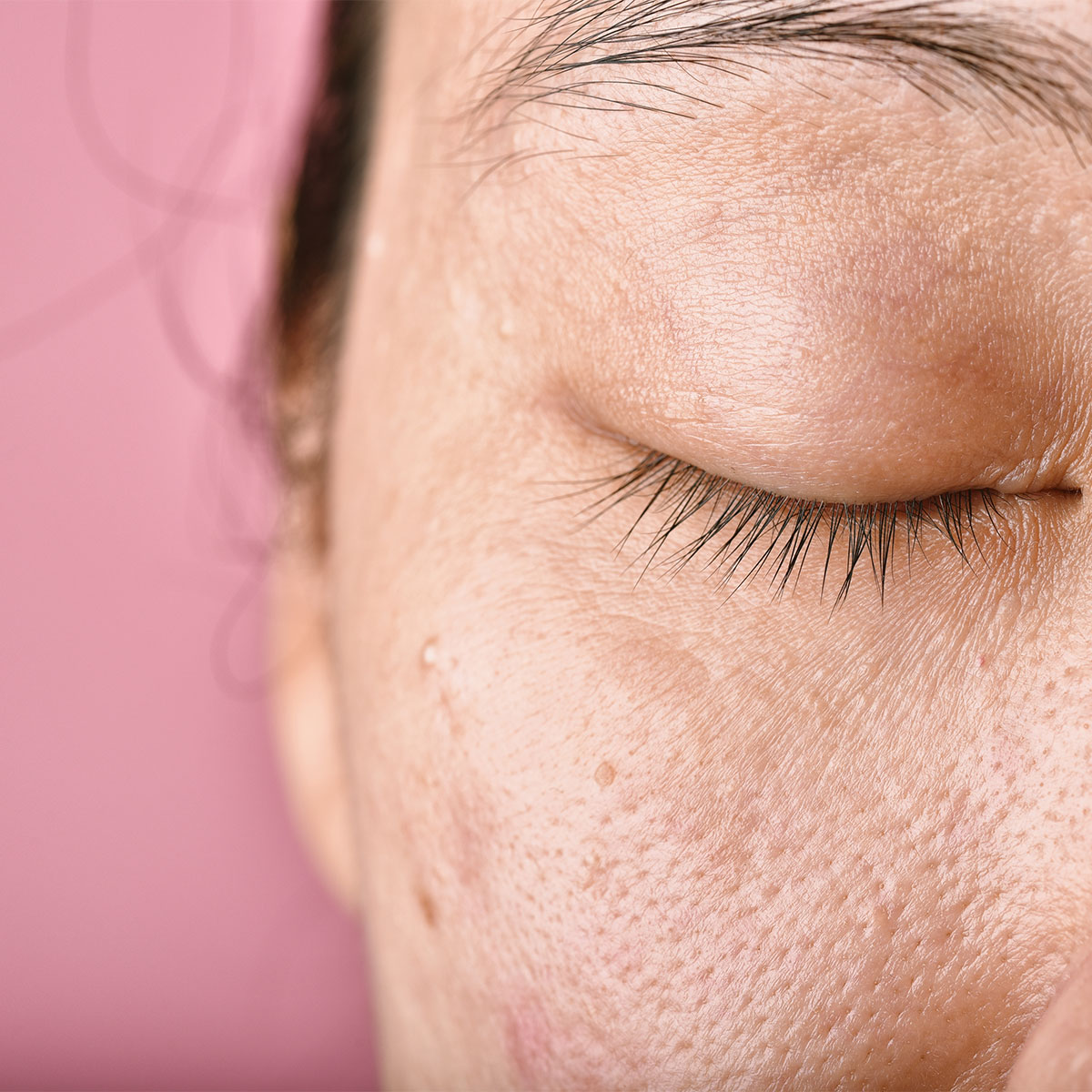 close-up photo of woman's dehydrated pores inflammation skin reaction