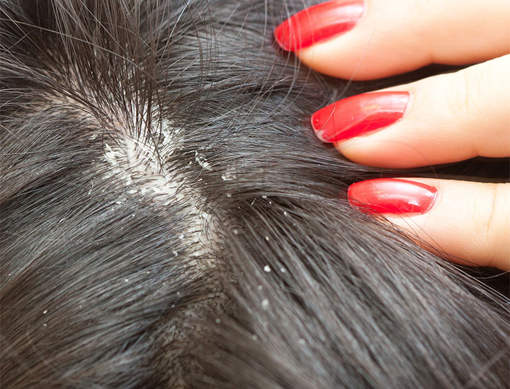 closeup-dandruff-flakes