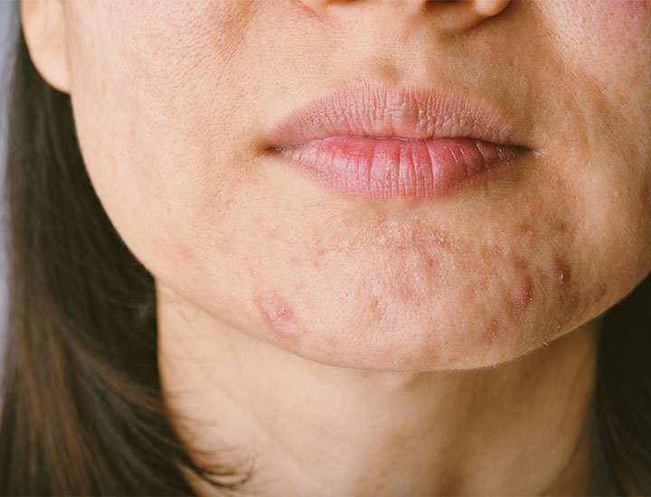 closeup-acne-chin