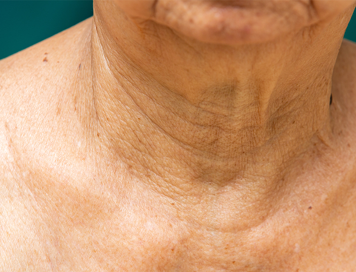 close-up shot of sagging textured wrinkled fine line aging neck skin