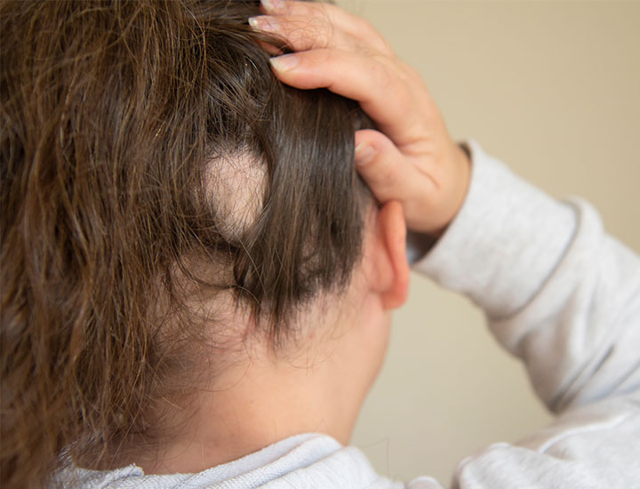 woman-bald-spots-scalp