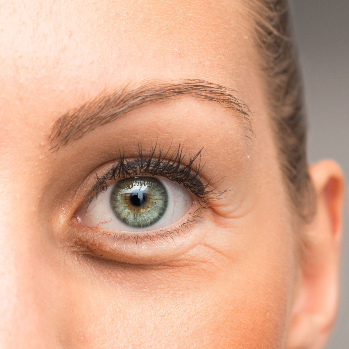 woman with dark under-eyes puffy swollen eye close-up