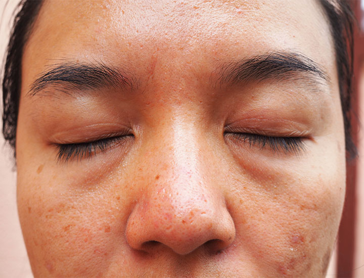 close-up puffy eye skin irritated sullen complexion