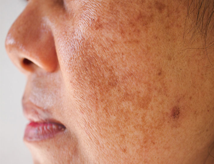 Why am I getting Dark Spots on my face? — GMARO Magazine