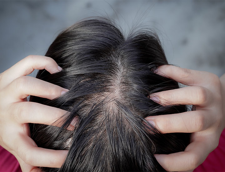 scalp-thinning-hair