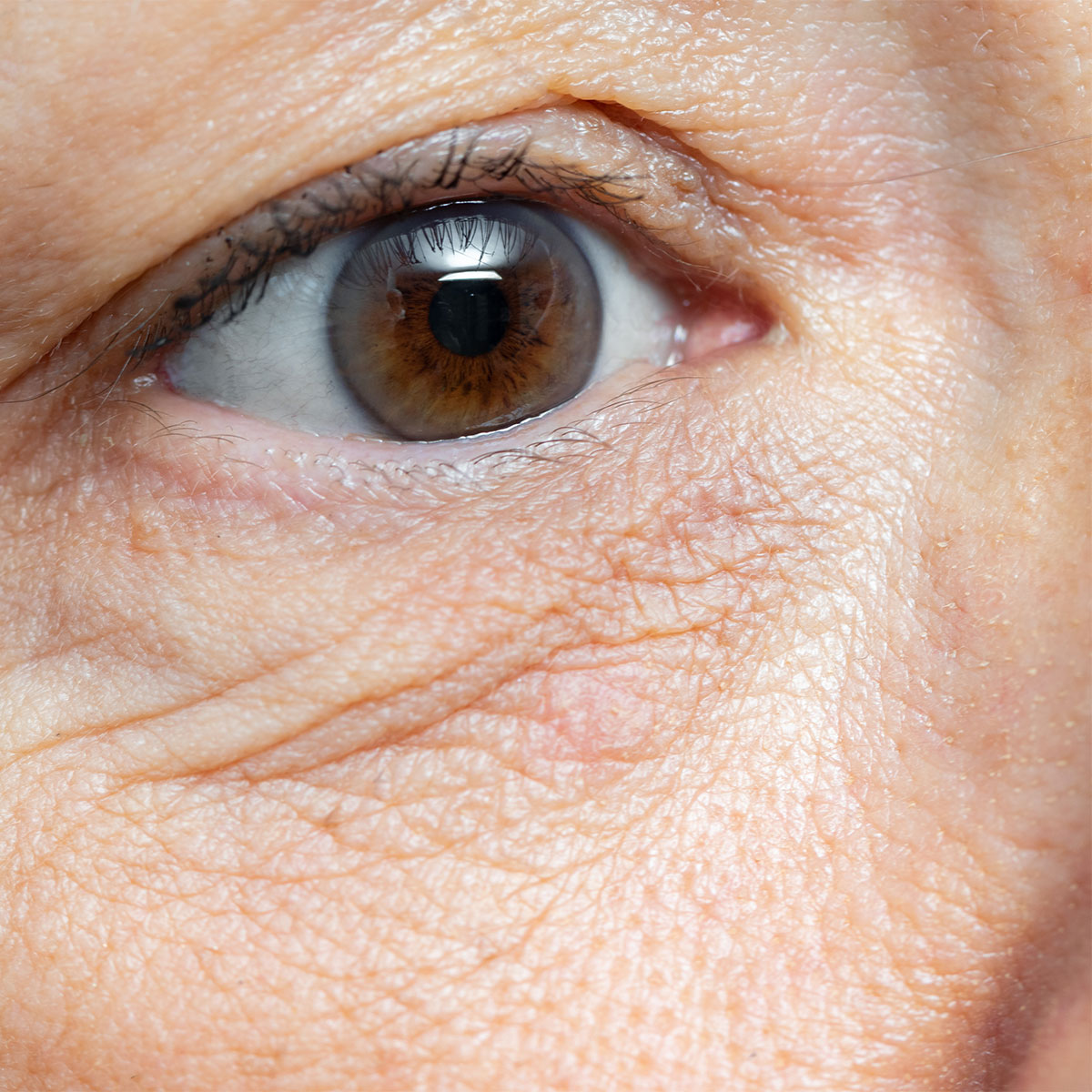 close-up shot woman's under-eye wrinkles dark circles
