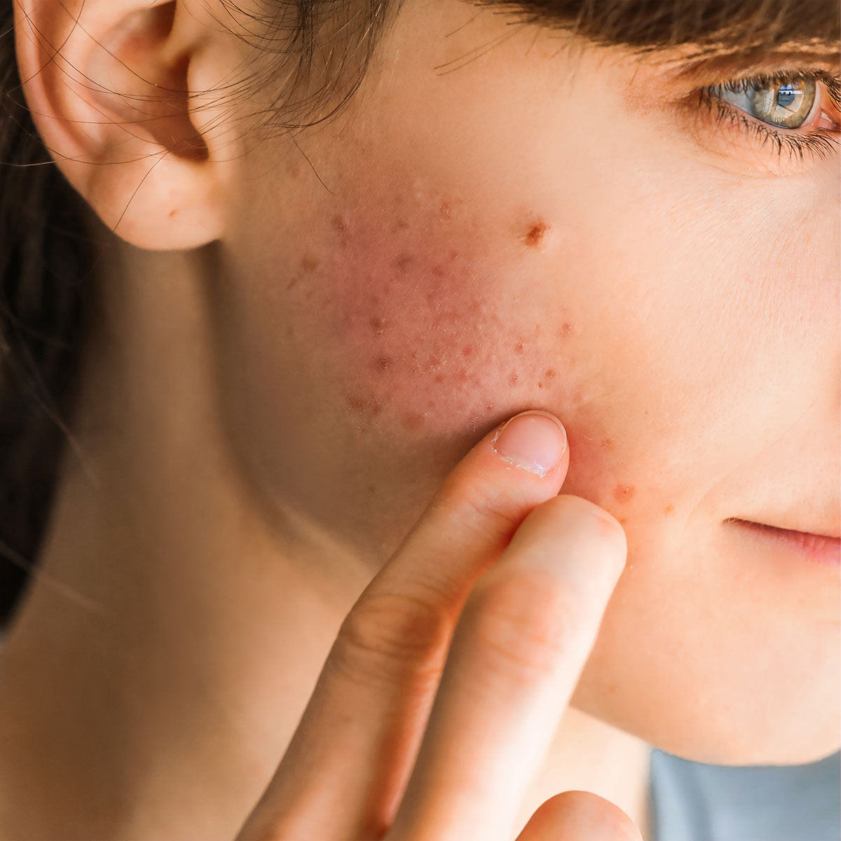 woman touching inflamed acne breakout on cheek red skin