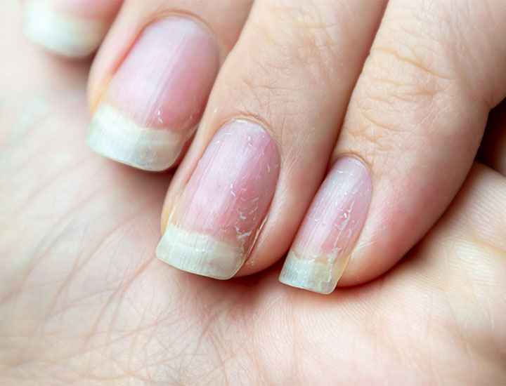 nails-growing-damage