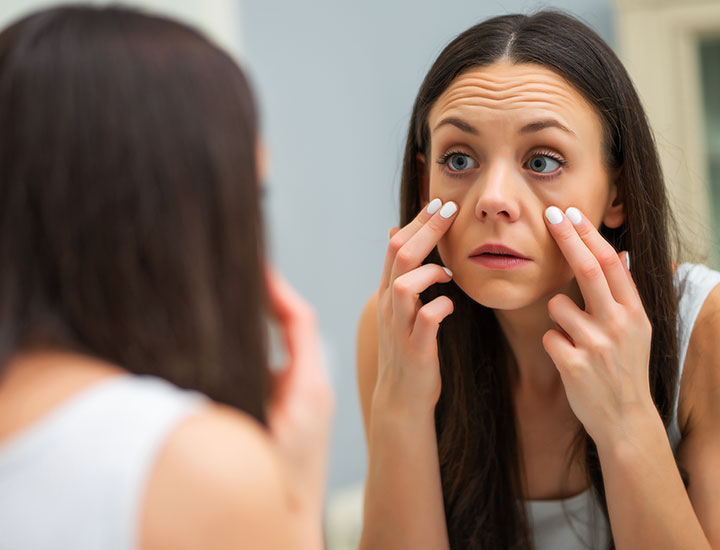 young-woman-dark-under-eyes