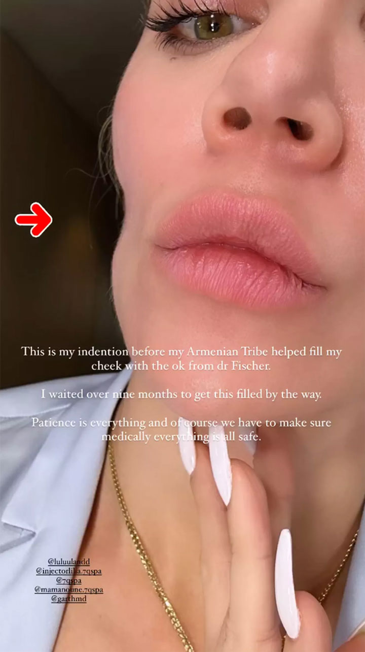 Khloe Kardashian showing cheek indentation on IG Story