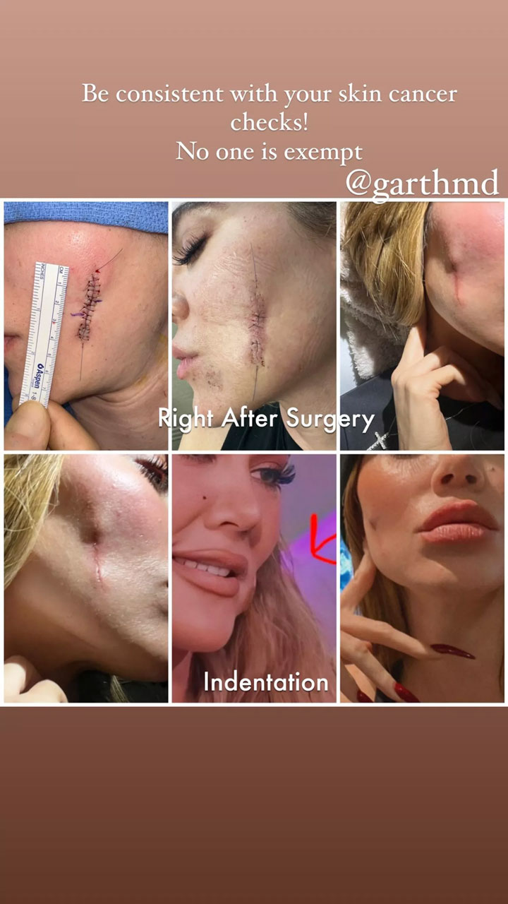 Khloe Kardashian showing skin cancer on IG Story