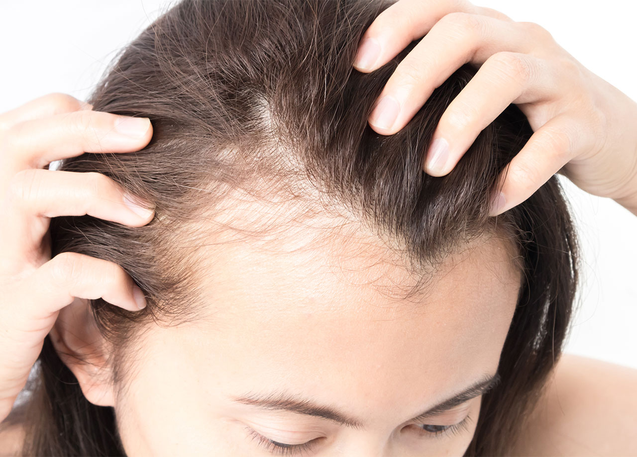 woman-experiencing-hair-loss-scalp