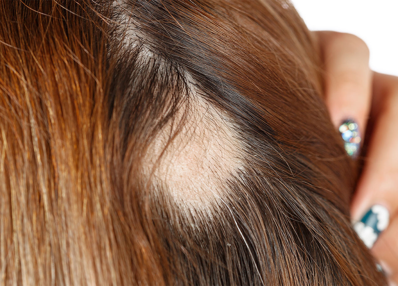 bald-spot-woman-scalp