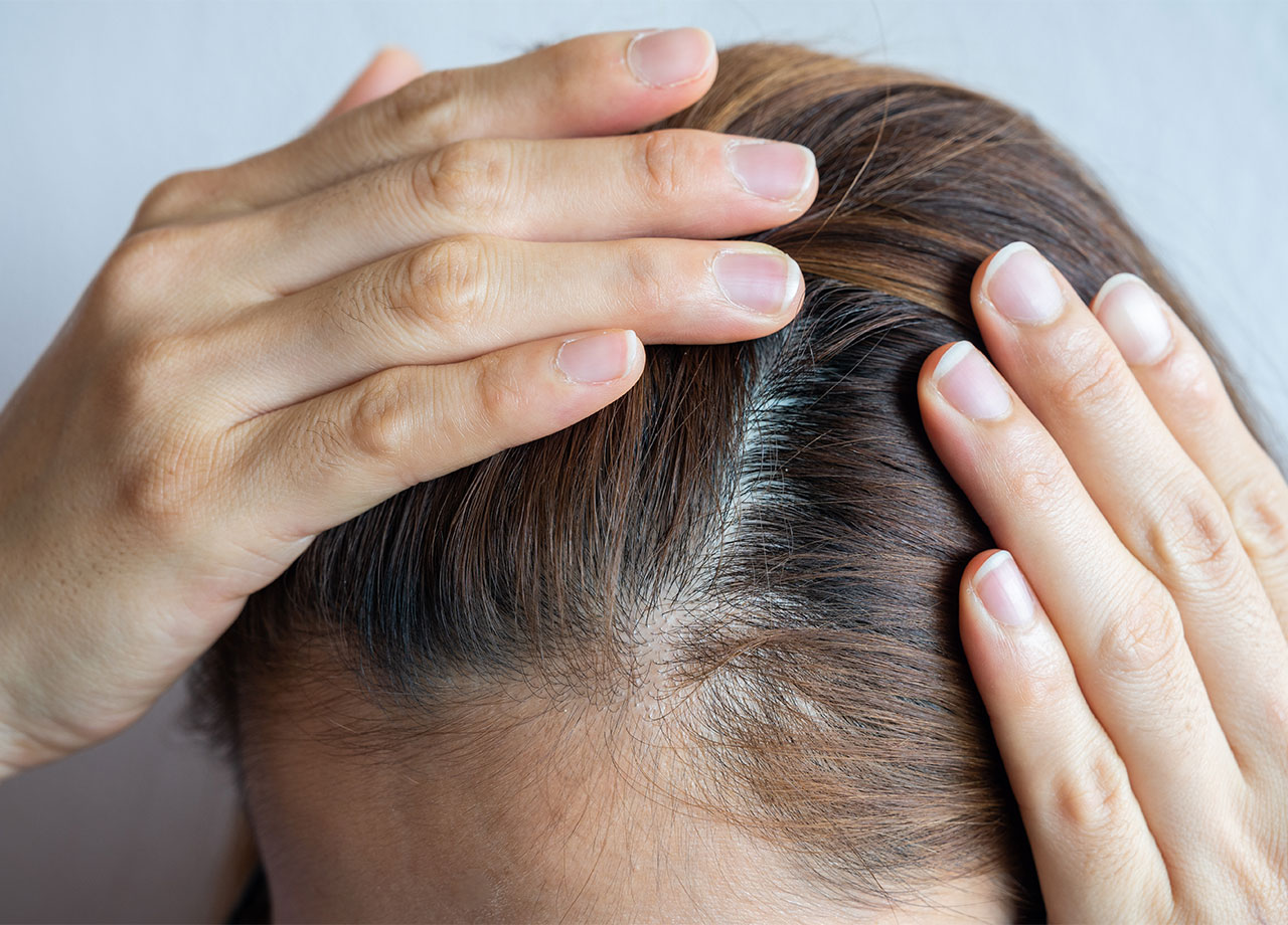 woman-scalp-balding-spots