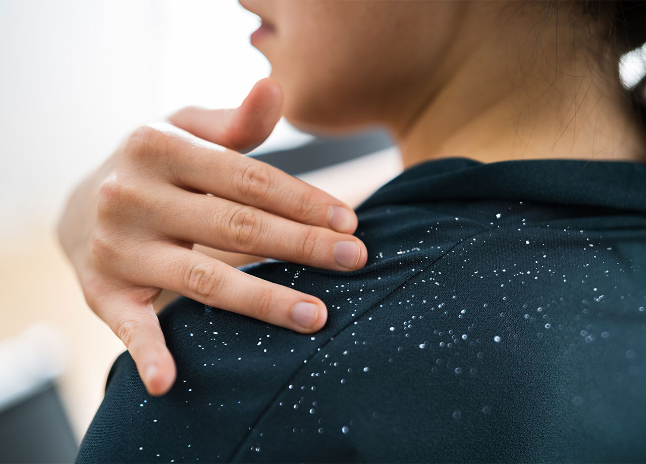 Woman with dandruff on her shoulder