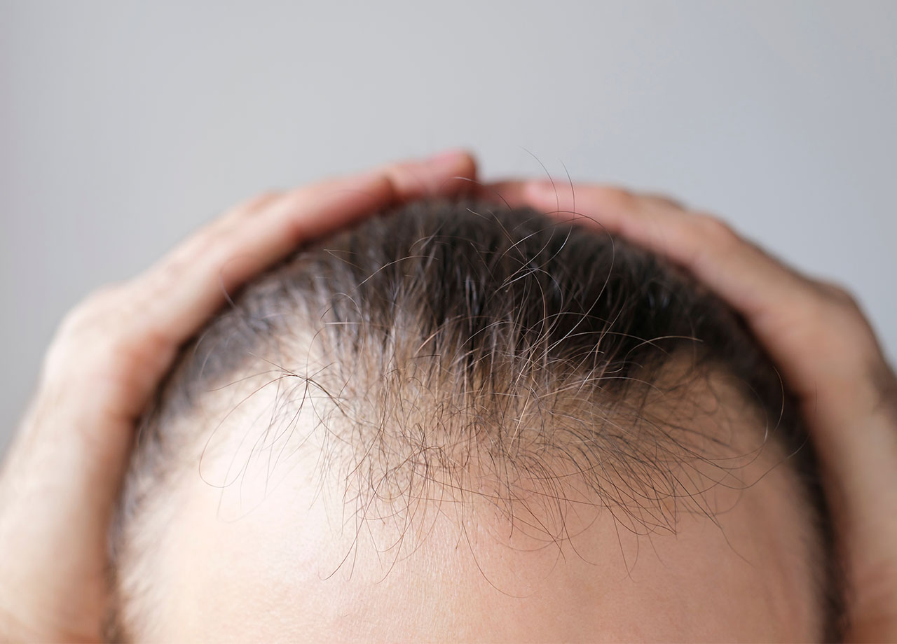 woman-scalp-sparse-hair