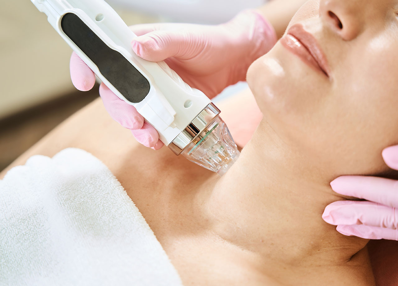 microneedling