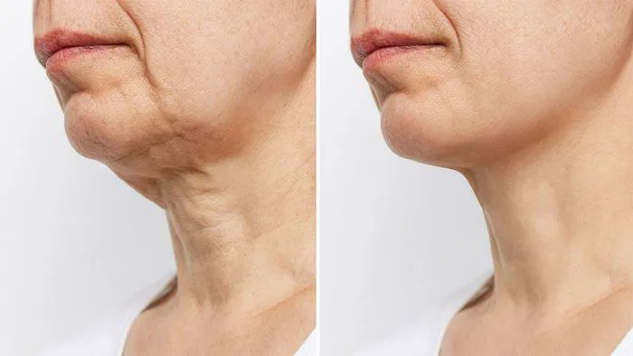 before-after-aging-neck