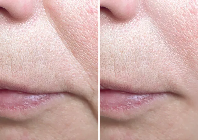 skin-wrinkles