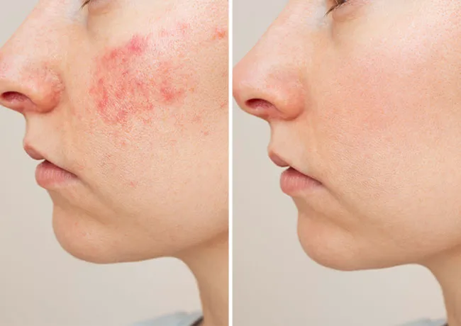 skin-redness