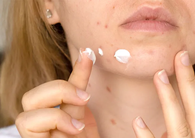toothpaste-on-pimples