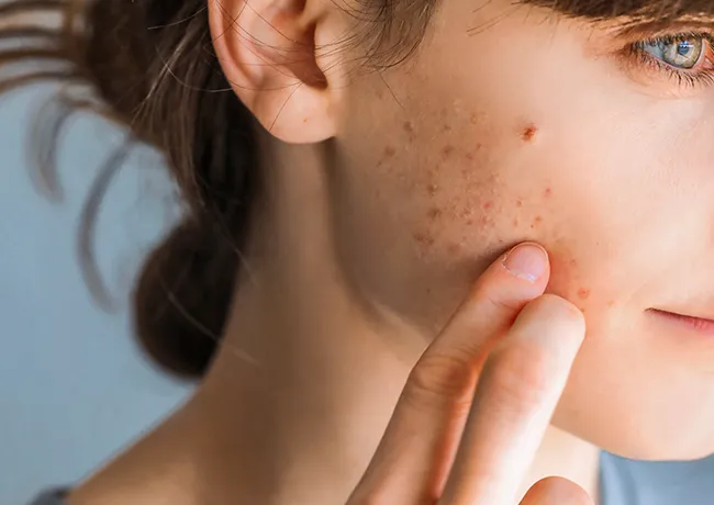 picking-at-pimples
